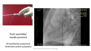 Push assembly/
needle puncture
(If satisfied by anatomical
landmarks and/or pulsation)
Trans Septal Puncture(TSP) in Cardiology
 