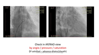 Check in AP/RAO view
by angio / pressure / saturation
(If satisfied – advance dilator/sheath)
Trans Septal Puncture(TSP) in Cardiology
 