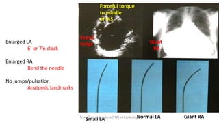 Giant RA
Small LA Normal LA
Septal
bulge Giant
RA
Forceful torque
to middle
of IAS
Enlarged LA
6’ or 7’o clock
Enlarged RA
Bend the needle
No jumps/pulsation
Anatomic landmarks
Trans Septal Puncture(TSP) in Cardiology
 
