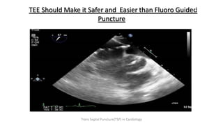 TEE Should Make it Safer and Easier than Fluoro Guided
Puncture
Trans Septal Puncture(TSP) in Cardiology
 