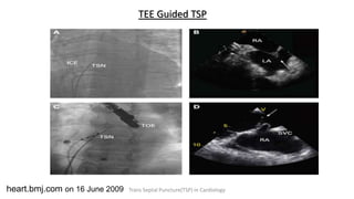 TEE Guided TSP
heart.bmj.com on 16 June 2009 Trans Septal Puncture(TSP) in Cardiology
 