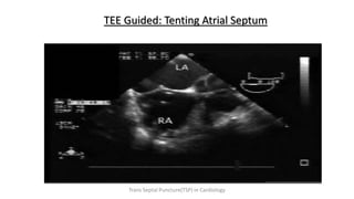 TEE Guided: Tenting Atrial Septum
Trans Septal Puncture(TSP) in Cardiology
 