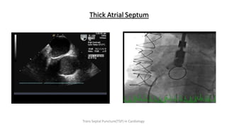 Thick Atrial Septum
Trans Septal Puncture(TSP) in Cardiology
 