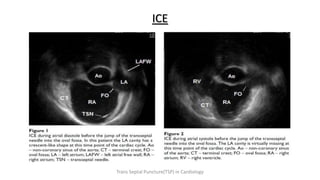ICE
Trans Septal Puncture(TSP) in Cardiology
 
