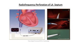 Radiofrequency Perforation of LA Septum
Trans Septal Puncture(TSP) in Cardiology
 