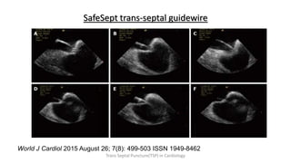 SafeSept trans-septal guidewire
World J Cardiol 2015 August 26; 7(8): 499-503 ISSN 1949-8462
Trans Septal Puncture(TSP) in Cardiology
 