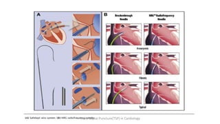 Trans Septal Puncture(TSP) in Cardiology
 