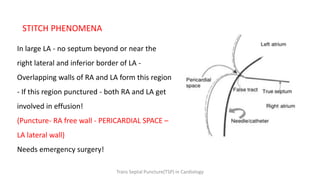STITCH PHENOMENA
In large LA - no septum beyond or near the
right lateral and inferior border of LA -
Overlapping walls of RA and LA form this region
- If this region punctured - both RA and LA get
involved in effusion!
(Puncture- RA free wall - PERICARDIAL SPACE –
LA lateral wall)
Needs emergency surgery!
Trans Septal Puncture(TSP) in Cardiology
 