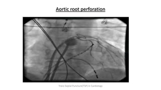 Aortic root perforation
Trans Septal Puncture(TSP) in Cardiology
 