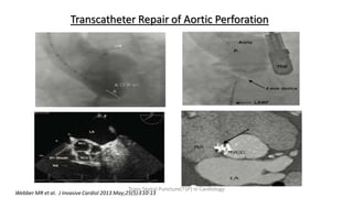 Transcatheter Repair of Aortic Perforation
Webber MR et al. J Invasive Cardiol 2013 May;25(5):E10-13
Trans Septal Puncture(TSP) in Cardiology
 