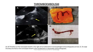 THROMBOEMBOLISM
(A, B) Thrombus on the transseptal sheath in the right atrium detected on transesophageal echocardiography (arrow). (C, D) Large
thrombus formed on the transseptal sheath in the LA detected on intracardiac echocardiography.
Trans Septal Puncture(TSP) in Cardiology
 