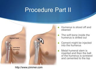 Procedure Part II

                        S Humerus is sliced off and
                          cleaned
                        S The soft bone inside the
                          humerus is drilled out
                        S Cement might be injected
                          into the humerus
                        S Metal humeral stem is
                          inserted and then the ball
                          of the humerus is screwed
                          and cemented to the top


http://www.zimmer.com
 