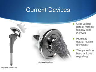 Current Devices

                                                    S Uses various
                                                      porous material
                                                      to allow bone
                                                      ingrowth

                                                    S Promotes
                                                      natural fixation
                                                      of implants

                                                    S The glenoid can
                                                      become loose
                                                      regardless

                            http://www.biomet.com


http://www.zimmer.com
 