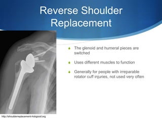 Reverse Shoulder
                                  Replacement

                                         S   The glenoid and humeral pieces are
                                             switched

                                         S   Uses different muscles to function

                                         S   Generally for people with irreparable
                                             rotator cuff injuries, not used very often




http://shoulderreplacement-hobgood.org
 