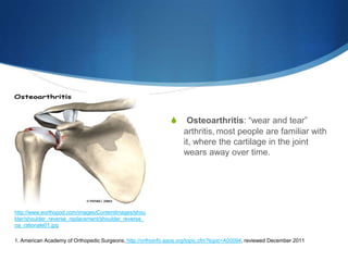 S     Osteoarthritis: “wear and tear”
                                                                   arthritis, most people are familiar with
                                                                   it, where the cartilage in the joint
                                                                   wears away over time.




http://www.eorthopod.com/images/ContentImages/shou
lder/shoulder_reverse_replacement/shoulder_reverse_
oa_rationale01.jpg

1. American Academy of Orthopedic Surgeons, http://orthoinfo.aaos.org/topic.cfm?topic=A00094, reviewed December 2011
 