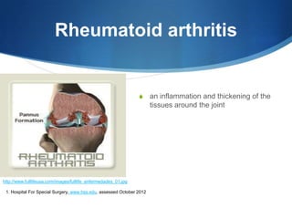 Rheumatoid arthritis


                                                                 S     an inflammation and thickening of the
                                                                       tissues around the joint




http://www.fulllifeusa.com/images/fulllife_enfermedades_01.jpg

 1. Hospital For Special Surgery, www.hss.edu, assessed October 2012
 