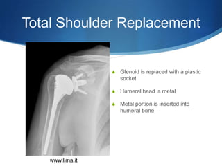 Total Shoulder Replacement


                  S   Glenoid is replaced with a plastic
                      socket

                  S   Humeral head is metal

                  S   Metal portion is inserted into
                      humeral bone




    www.lima.it
 