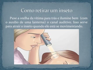 Puxe a orelha da vítima para trás e ilumine bem (com
o auxílio de uma lanterna) o canal auditivo. Isso serve
para atrair o inseto quando ele está se movimentando.
 