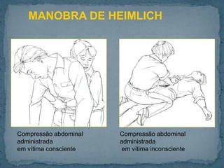 Compressão abdominal
administrada
em vítima consciente
Compressão abdominal
administrada
em vítima inconsciente
MANOBRA DE HEIMLICH
 