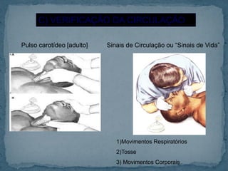 C) VERIFICAÇÃO DA CIRCULAÇÃO
Pulso carotídeo [adulto] Sinais de Circulação ou “Sinais de Vida”
1)Movimentos Respiratórios
2)Tosse
3) Movimentos Corporais
 