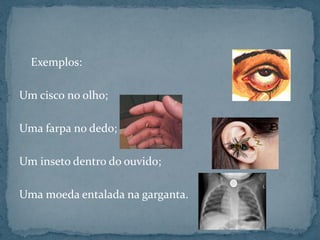 Exemplos:
Um cisco no olho;
Uma farpa no dedo;
Um inseto dentro do ouvido;
Uma moeda entalada na garganta.
 