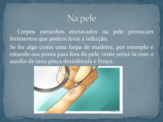 Corpos estranhos encravados na pele provocam
ferimentos que podem levar a infecção.
Se for algo como uma farpa de madeira, por exemplo e
estando sua ponta para fora da pele, tente retirá-la com o
auxílio de uma pinça desinfetada e limpa.
 