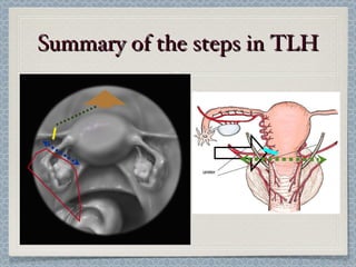 Laparascopic Hysterectomy, technical aspect | PPT