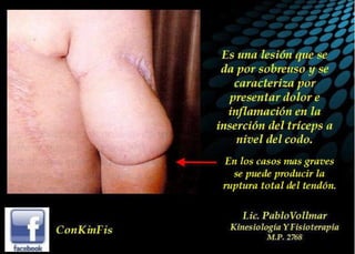 Tendinitis del Triceps