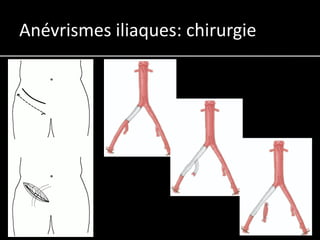 Anévrismes iliaques: chirurgie
 