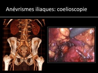 Anévrismes iliaques: coelioscopie
 