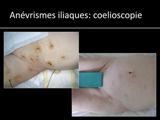 Anévrismes iliaques: coelioscopie
 