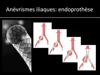 Anévrismes iliaques: endoprothèse
 
