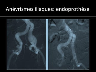 Anévrismes iliaques: endoprothèse
 