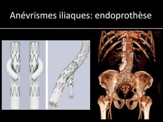 Anévrismes iliaques: endoprothèse
 