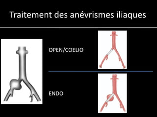 Traitement des anévrismes iliaques


         OPEN/COELIO




         ENDO
 