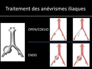 Traitement des anévrismes iliaques


         OPEN/COELIO




         ENDO
 