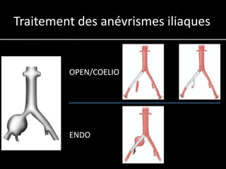 Traitement des anévrismes iliaques


         OPEN/COELIO




         ENDO
 