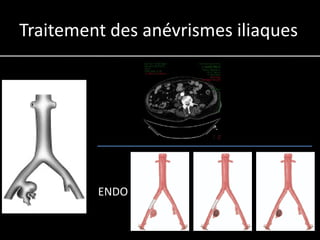 Traitement des anévrismes iliaques




         ENDO
 