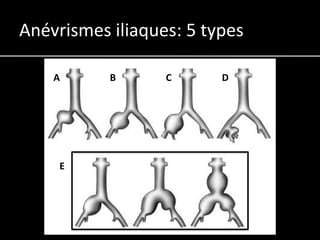 Anévrismes iliaques: 5 types

    A      B      C      D




     E
 