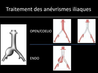 Traitement des anévrismes iliaques


         OPEN/COELIO




         ENDO
 