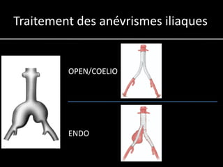 Traitement des anévrismes iliaques


         OPEN/COELIO




         ENDO
 