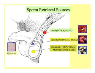 Vasal (MVSA; PVSA)
Epididymal (MESA, PESA)
Testicular (TESA, TESE,
Microdissection TESE)
Sperm Retrieval Sources
Ejaculate
 