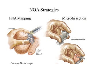 MicrodissectionFNA Mapping 	

NOA Strategies	

Courtesy: Netter Images	

 
