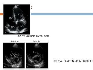 2D ECHO
RA RV VOLUME OVERLOAD
SEPTAL FLATTENING IN DIASTOLE
 