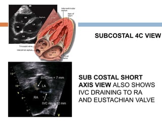 SUBCOSTAL 4C VIEW
SUB COSTAL SHORT
AXIS VIEW ALSO SHOWS
IVC DRAINING TO RA
AND EUSTACHIAN VALVE
 