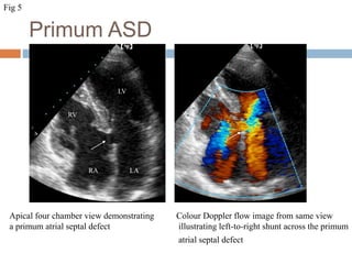 Primum ASD
LARA
LV
RV
Apical four chamber view demonstrating
a primum atrial septal defect
Colour Doppler flow image from same view
illustrating left-to-right shunt across the primum
atrial septal defect
Fig 5
 