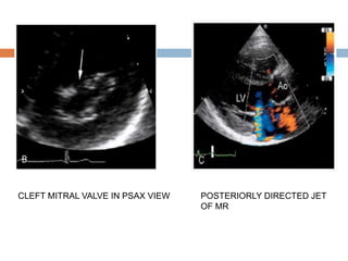 CLEFT MITRAL VALVE IN PSAX VIEW POSTERIORLY DIRECTED JET
OF MR
 