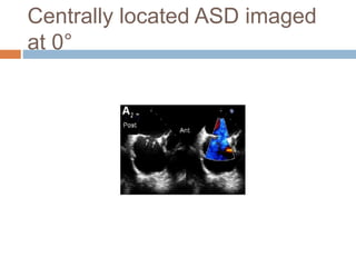 Centrally located ASD imaged
at 0°
 