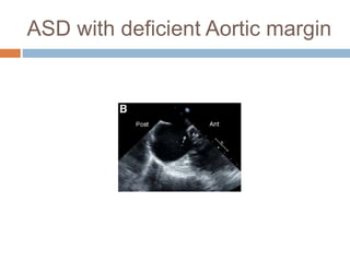 ASD with deficient Aortic margin
 