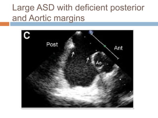 Large ASD with deficient posterior
and Aortic margins
 